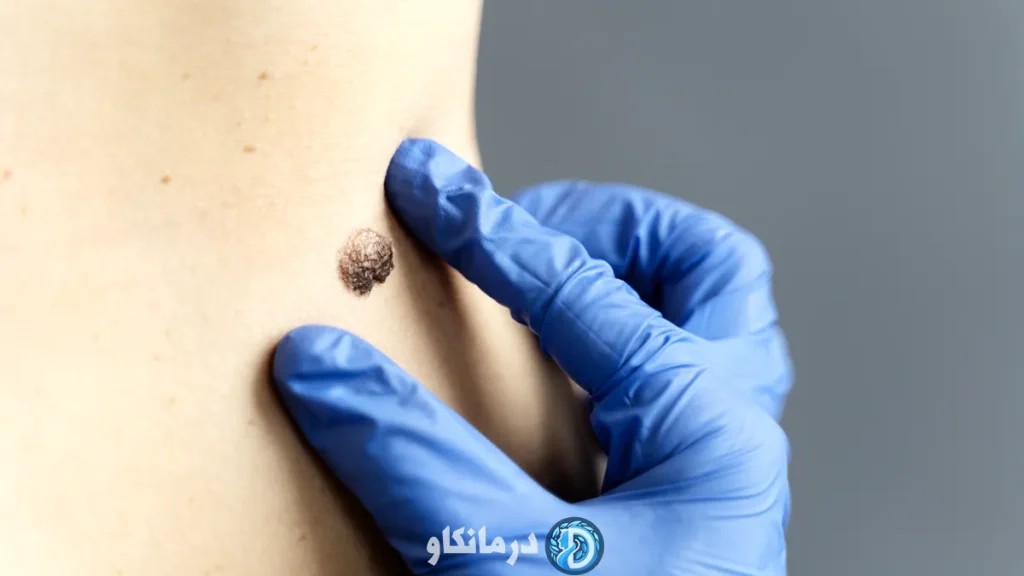 علائم اولیه سرطان پوست که باید جدی گرفته شوند 2 علائم اولیه سرطان پوست