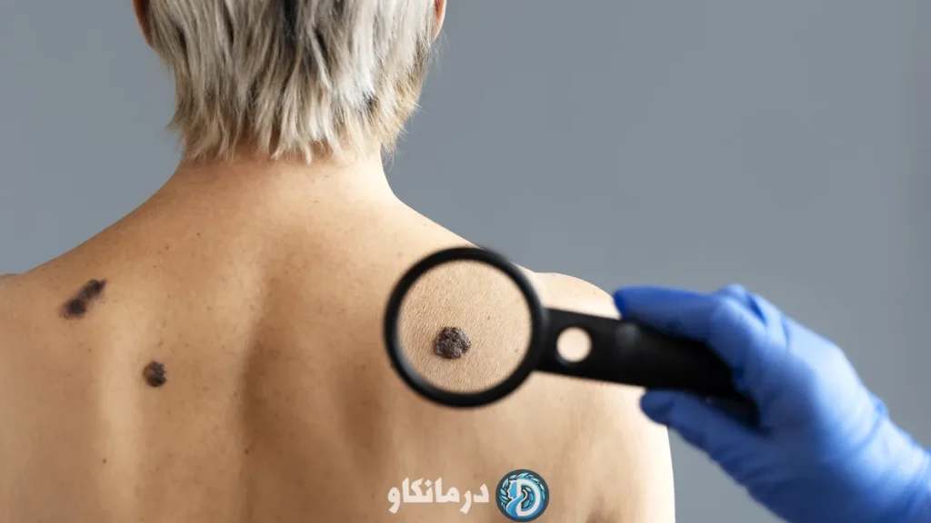 علائم اولیه سرطان پوست که باید جدی گرفته شوند 3 علائم اولیه سرطان پوست